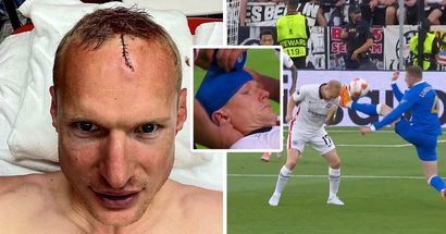 Frankfurt player Sebastian Rode shows off stitches after boot to the face