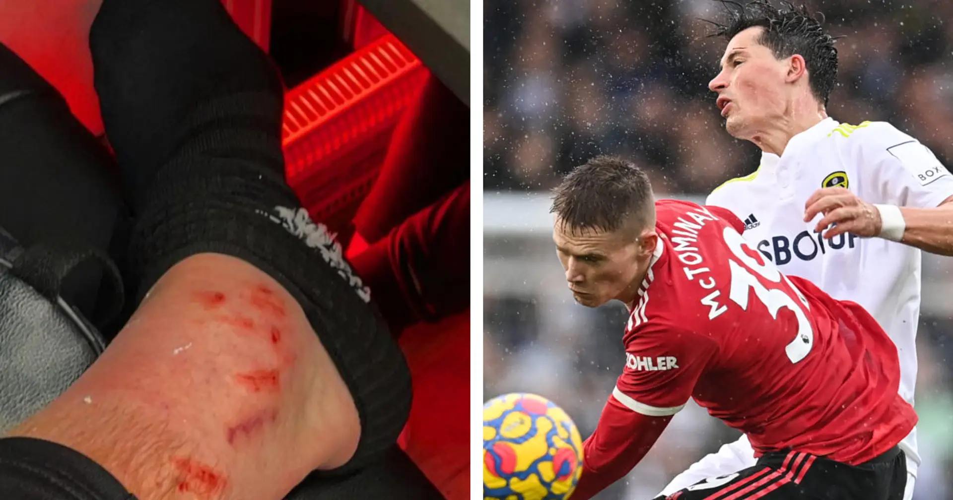 Scott McTominay shares bloody photo of bruises after Leeds win