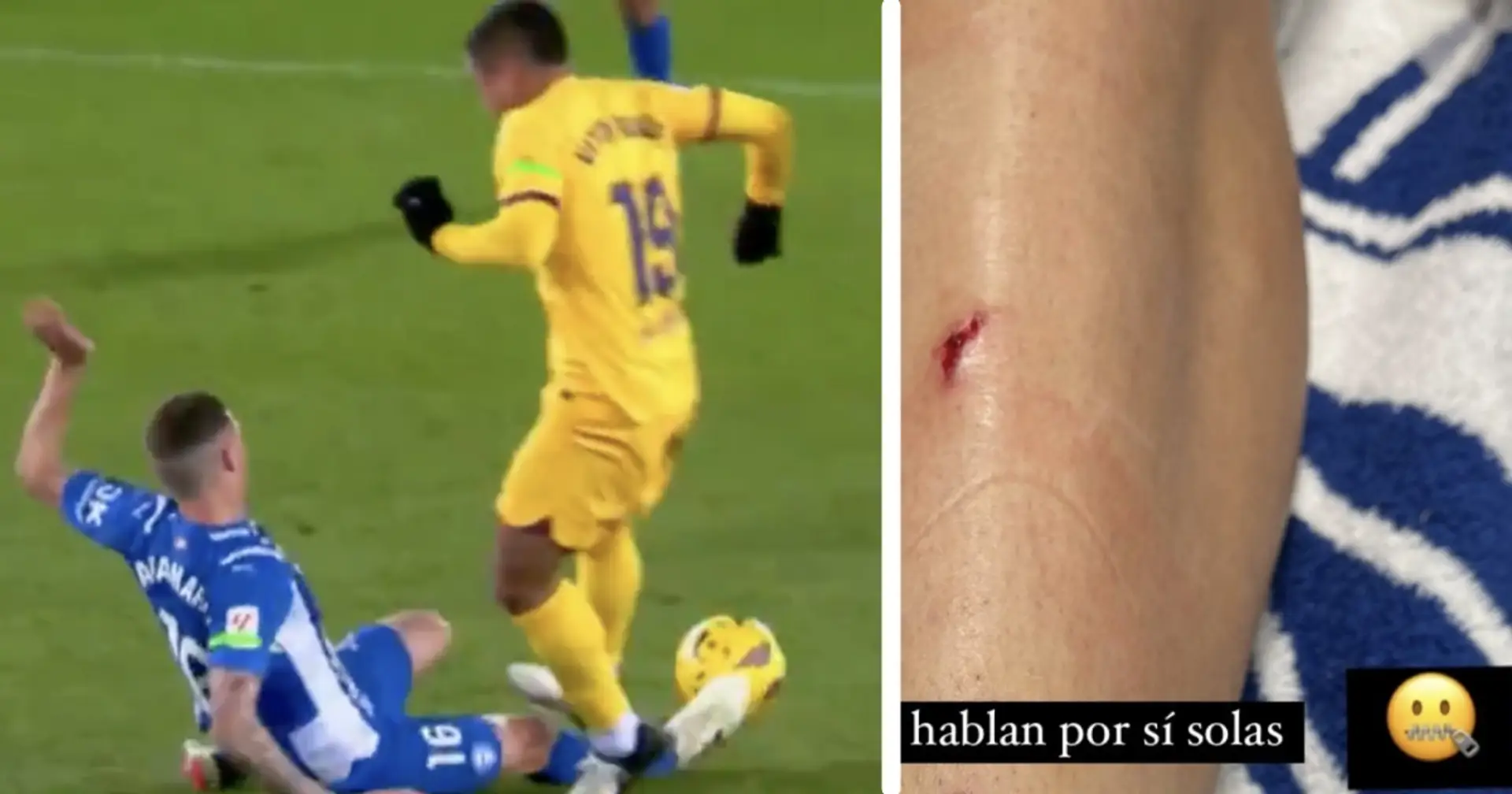 El defensa del Alavés, cedido del Real Madrid, muestra la pierna lesionada tras la polémica tarjeta roja de Vitor Roque