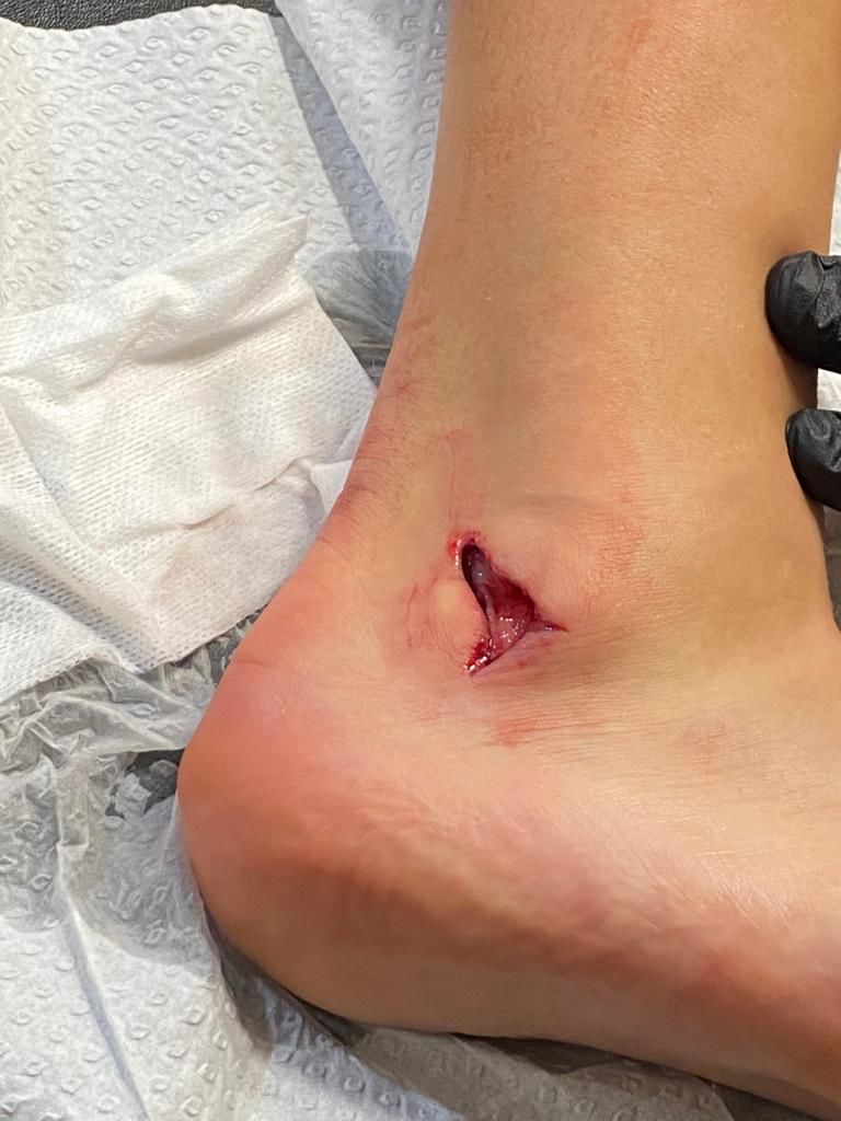 Далот выложил ужасную фотографию травмы, которую он получил в матче с «Астон Виллой»
