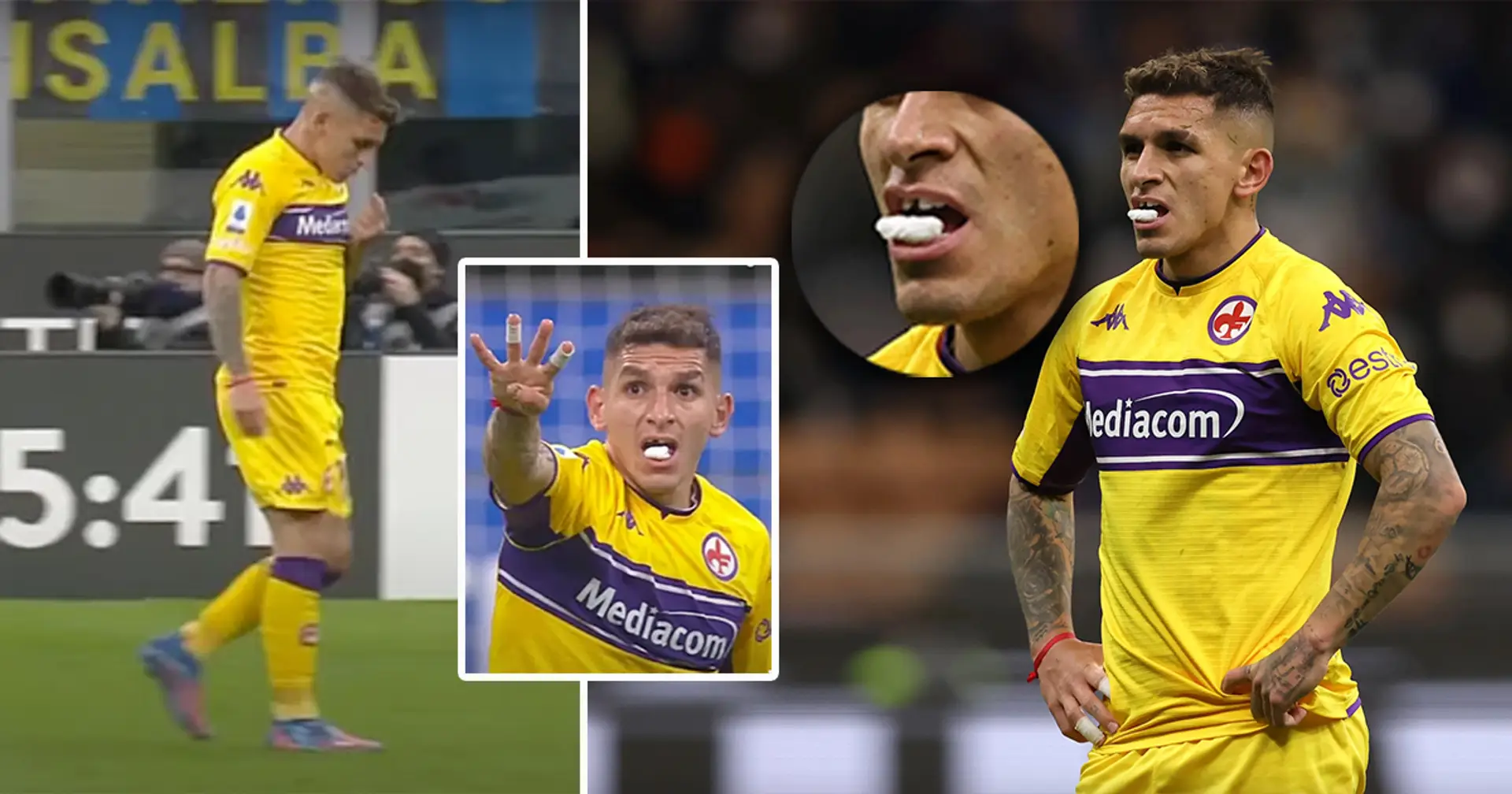 Lucas Torreira lost his tooth yesterday while playing against Inter Milan