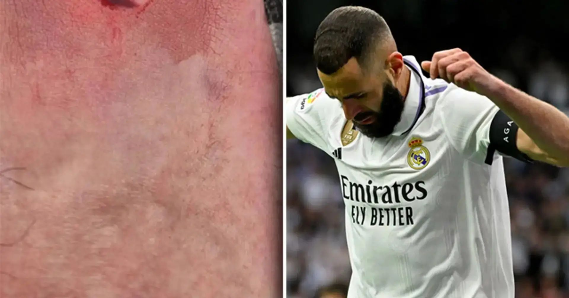 Wow, es gibt Fotos von Benzemas Verletzung (5 Stiche): Man kann nicht glauben, dass er danach auch noch getroffen hat