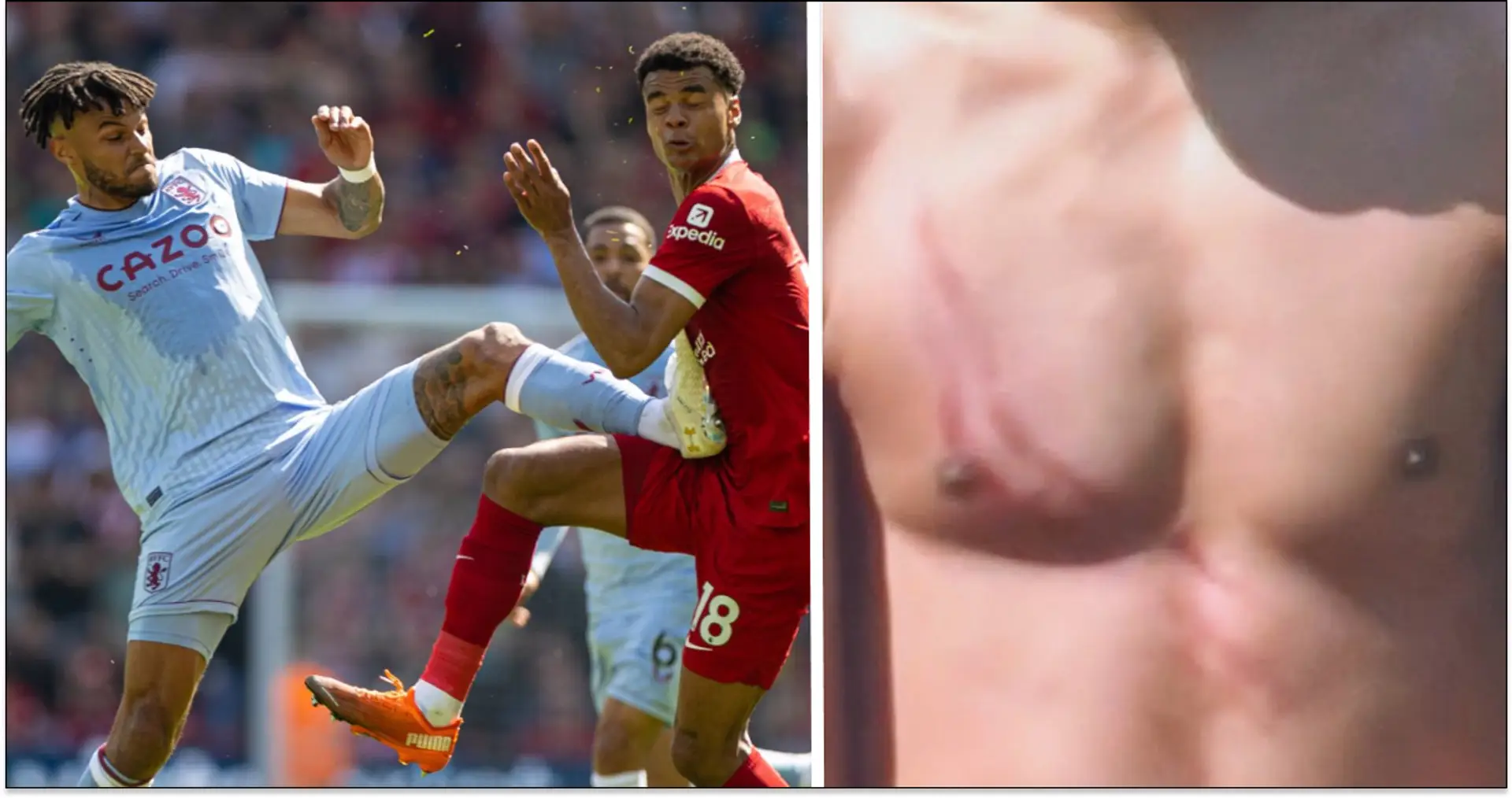 Spotted: Stud marks on Gakpo's body after Mings brutal high-boot challenge